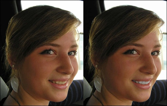 whiten-teeth-to-improve-a-smile